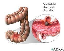 diverticulos